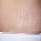 چه روش هایی برای از بین بردن ترک های پوستی روی شکم و ران‌ها وجود دارد؟